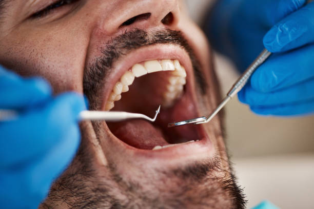 Best Emergency Wisdom Teeth Removal in Potomac, MD